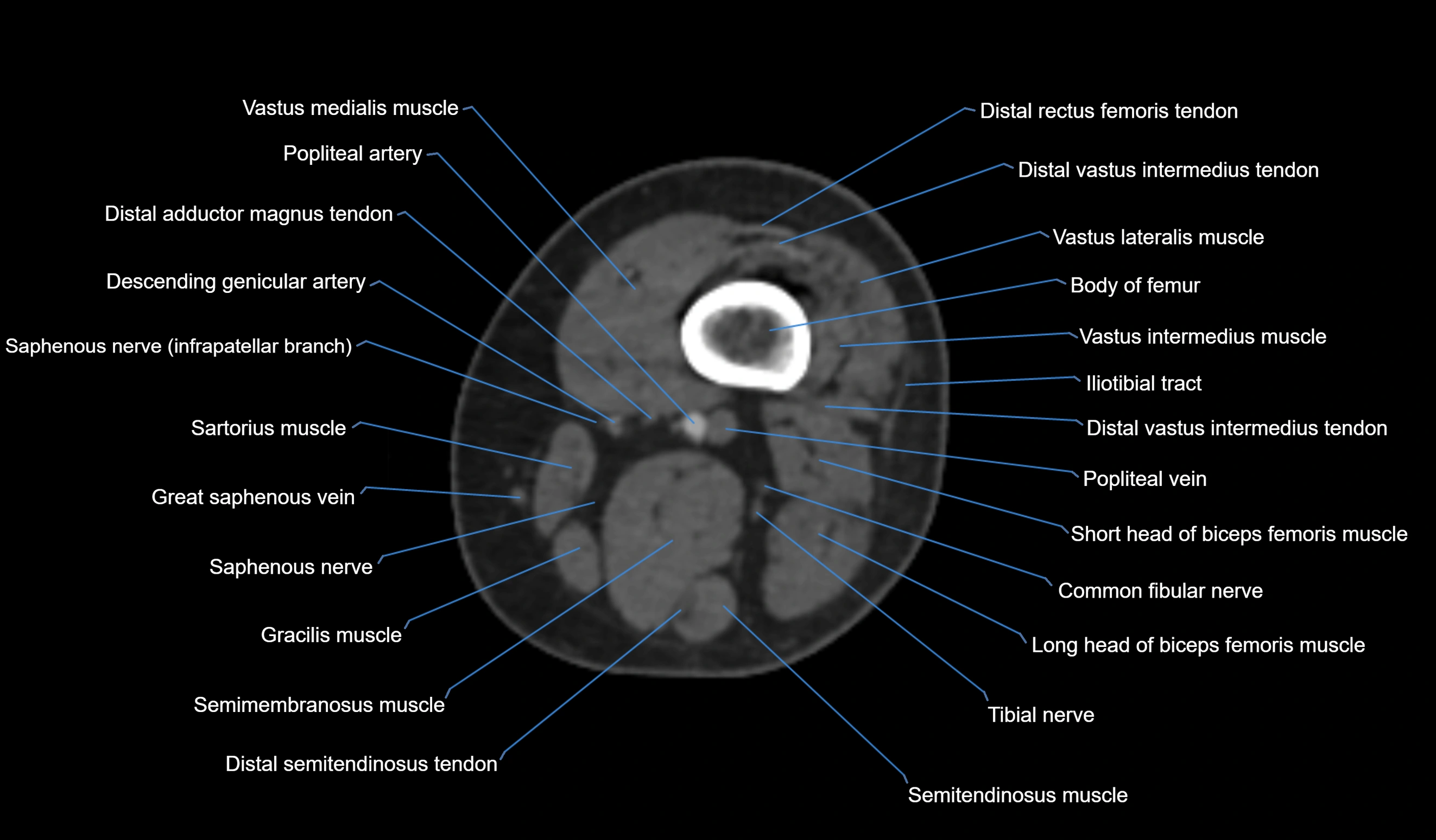 CT knee axial cross sectional anatomy labelled image-00001.webp